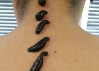 Пиявки медицинские: достоинства и описание, правила применения